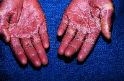 <p>A <strong><mark data-color="red" style="background-color: red; color: inherit">rare, life-threatening condition</mark></strong> caused by <strong><mark data-color="purple" style="background-color: purple; color: inherit">Staphylococcus aureus</mark></strong>, <strong>caused by an infection. It can happen when using a tampon or menstrual cup, or from an infected wound. </strong></p><p><u>Symptoms include:</u></p><ul><li><p>a high temperature</p></li><li><p>muscle aches</p></li><li><p>a raised skin rash that feels like sandpaper</p></li><li><p>flu-like symptoms</p></li></ul><p></p>