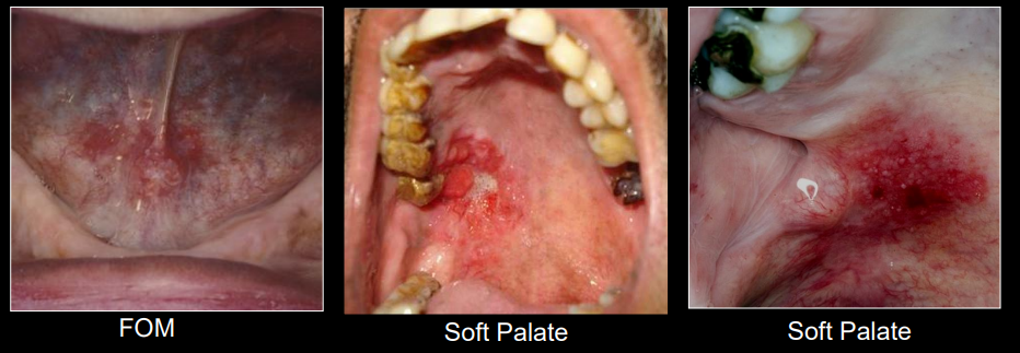 <p>lateral/ventral tongue, FOM, soft palate</p>
