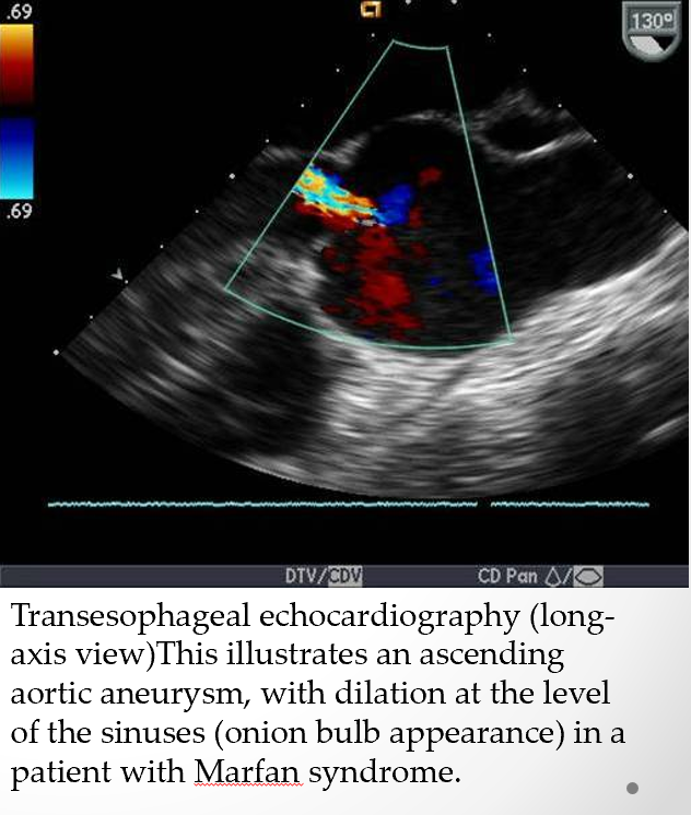 <p>marfan syndrome (tall people) </p><p>familial aortic aneurysm </p><p>hypertension</p><p>aortic dissection </p>