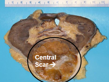 <p>Oncocytoma</p>