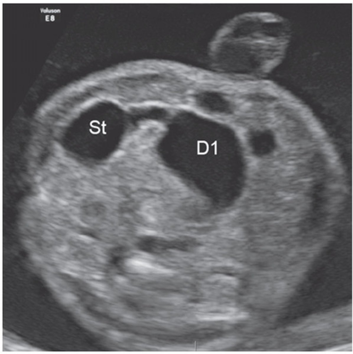 <p>Down syndrome, but can also occur as an isolated condition, will have a double bubble sonographic appearance</p>