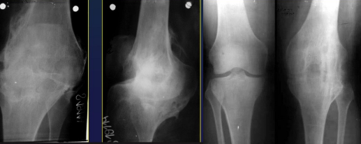 <p>Disappearance of joint space => bone fusion across a joint</p><p> </p><p>ONLY produced by arthritis</p><p>NEVER produced by arthrosis</p>