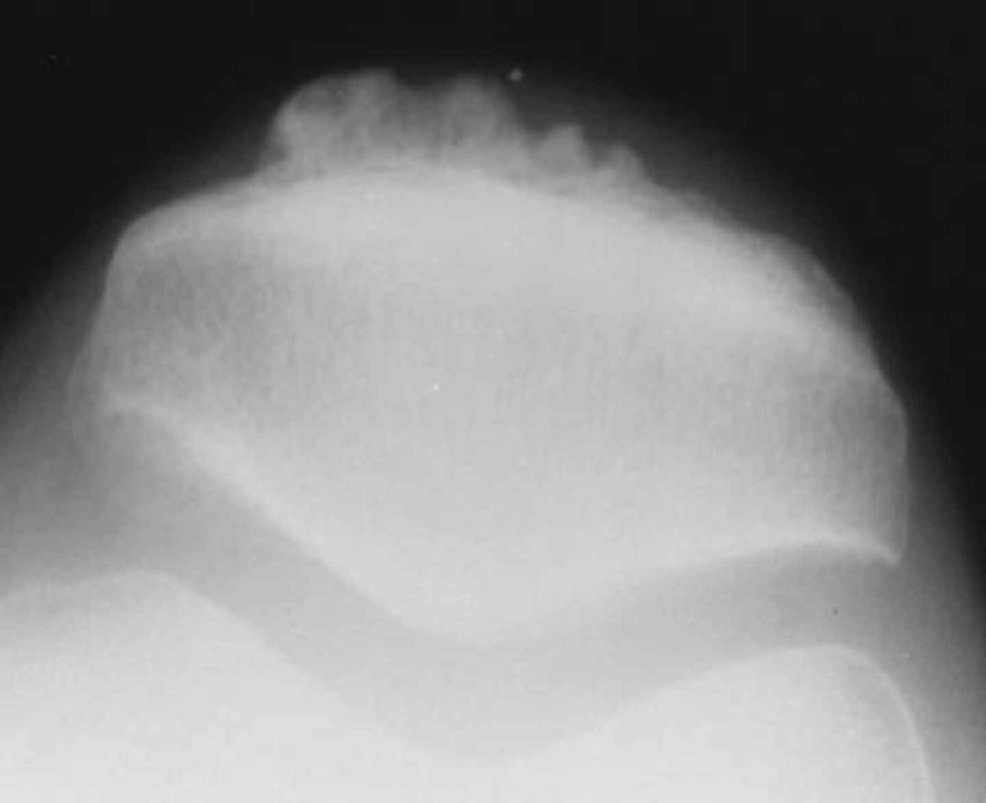 <p>ID radiographic feature of osteoarthrosis of the knee joint</p>