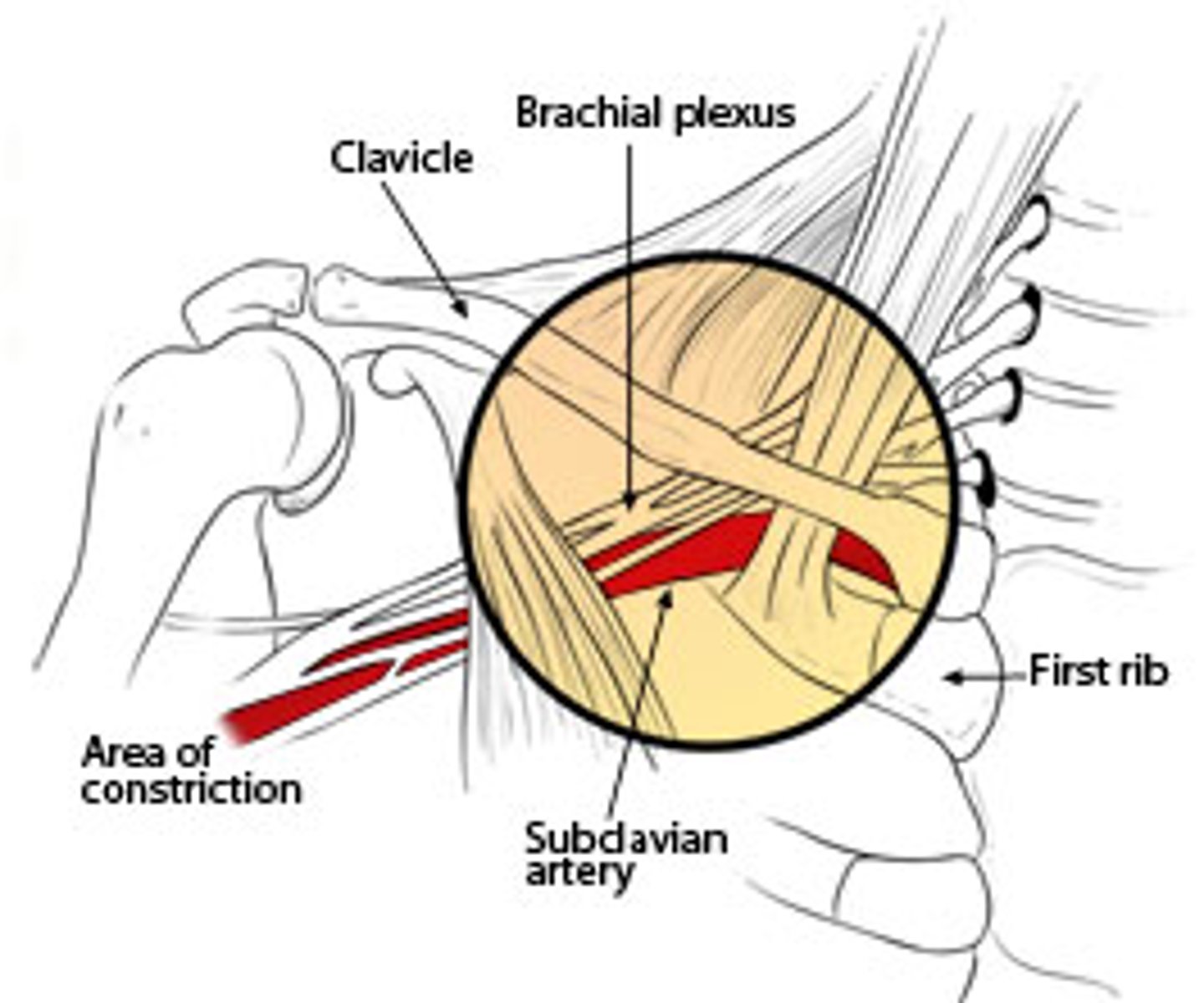 <p>Injury: compression of the lower trunk and subclavian vessels</p><p>Causes:</p><p>- cervical rib</p><p>- pancoast tumor</p><p>Muscle Deficit/Functional Deficit:</p><p>- same as klumpke palsy</p><p>Presentation:</p><p>- atrophy of intrinsic hand muscles</p><p>- ischemia, pain, and edema due to vascular compression</p>