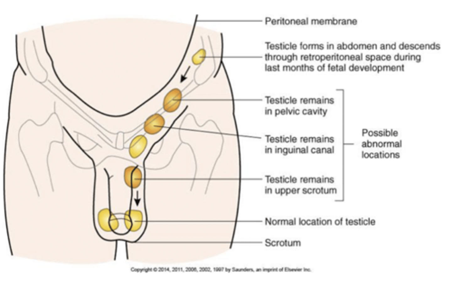 <p>the testes fail to descend into the scrotum properly</p><p>ectopic testis - the testis are positioned outside of the scrotum that can cause degeneration of seminiferous tubules and impair spermatogenesis. testicular cancer risk is increased</p>