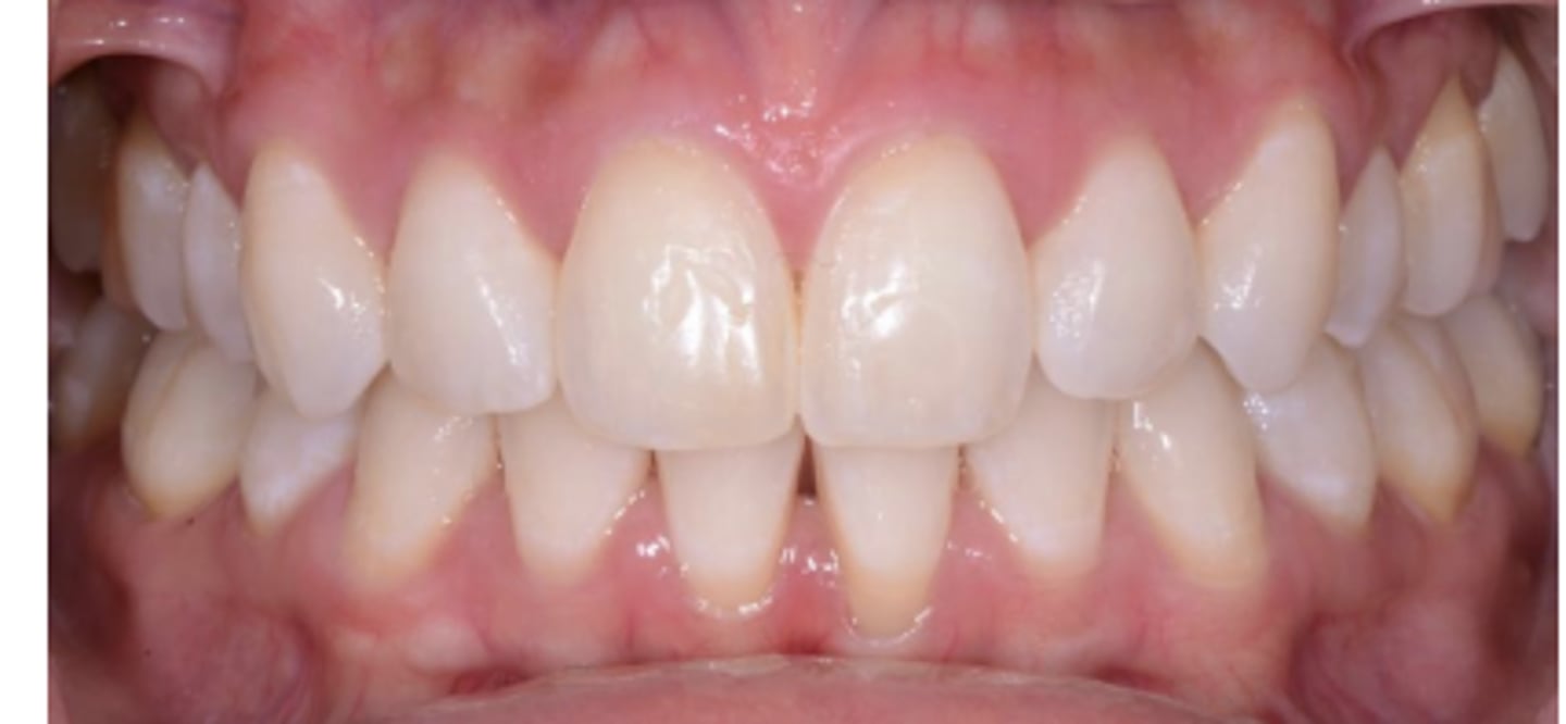 <p>Triangular or oval shaped teeth</p><p>Highly scalloped gingival margin</p><p>Delicate and friable tissue</p>