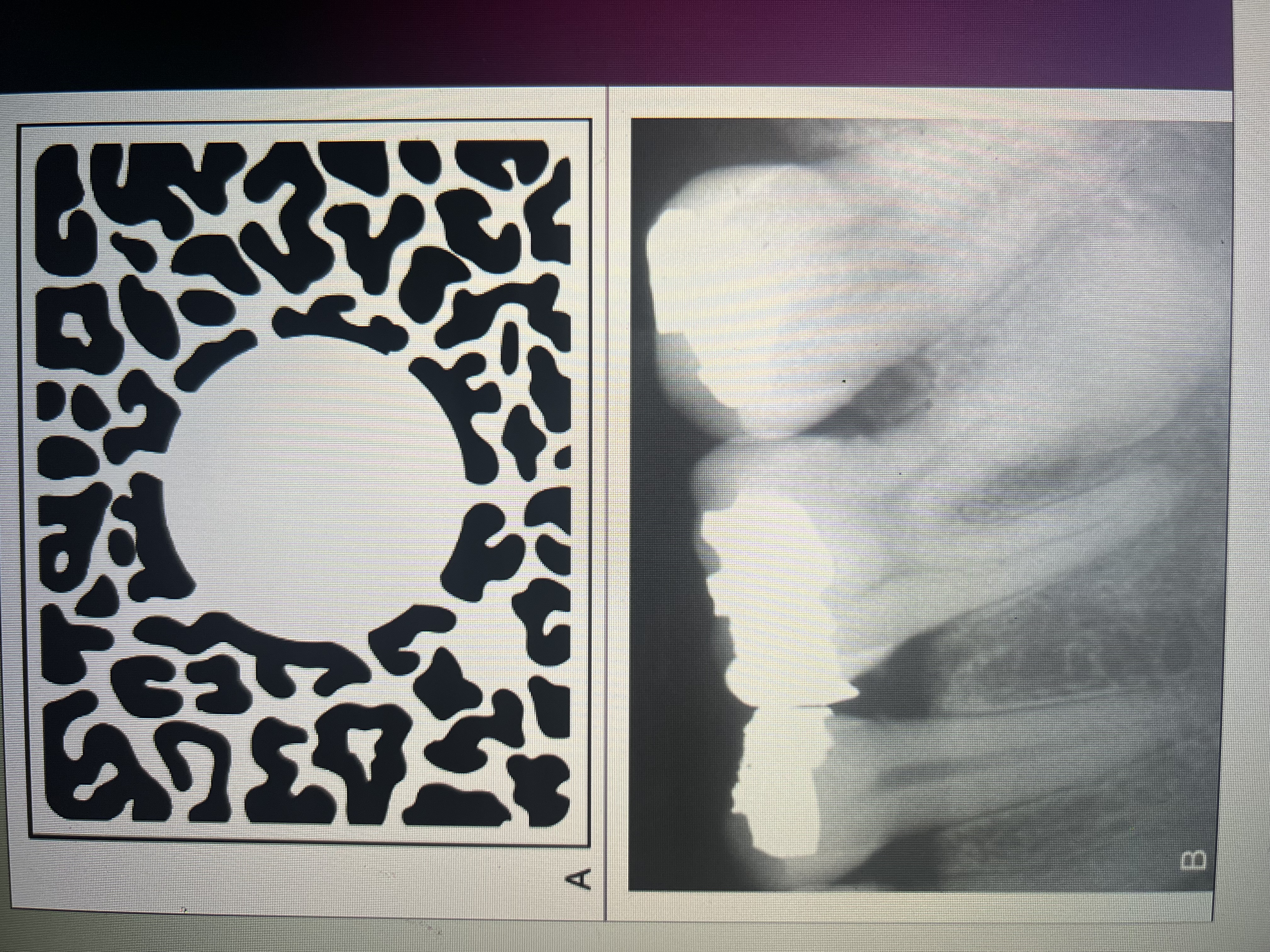 <p>Focal opacity</p>