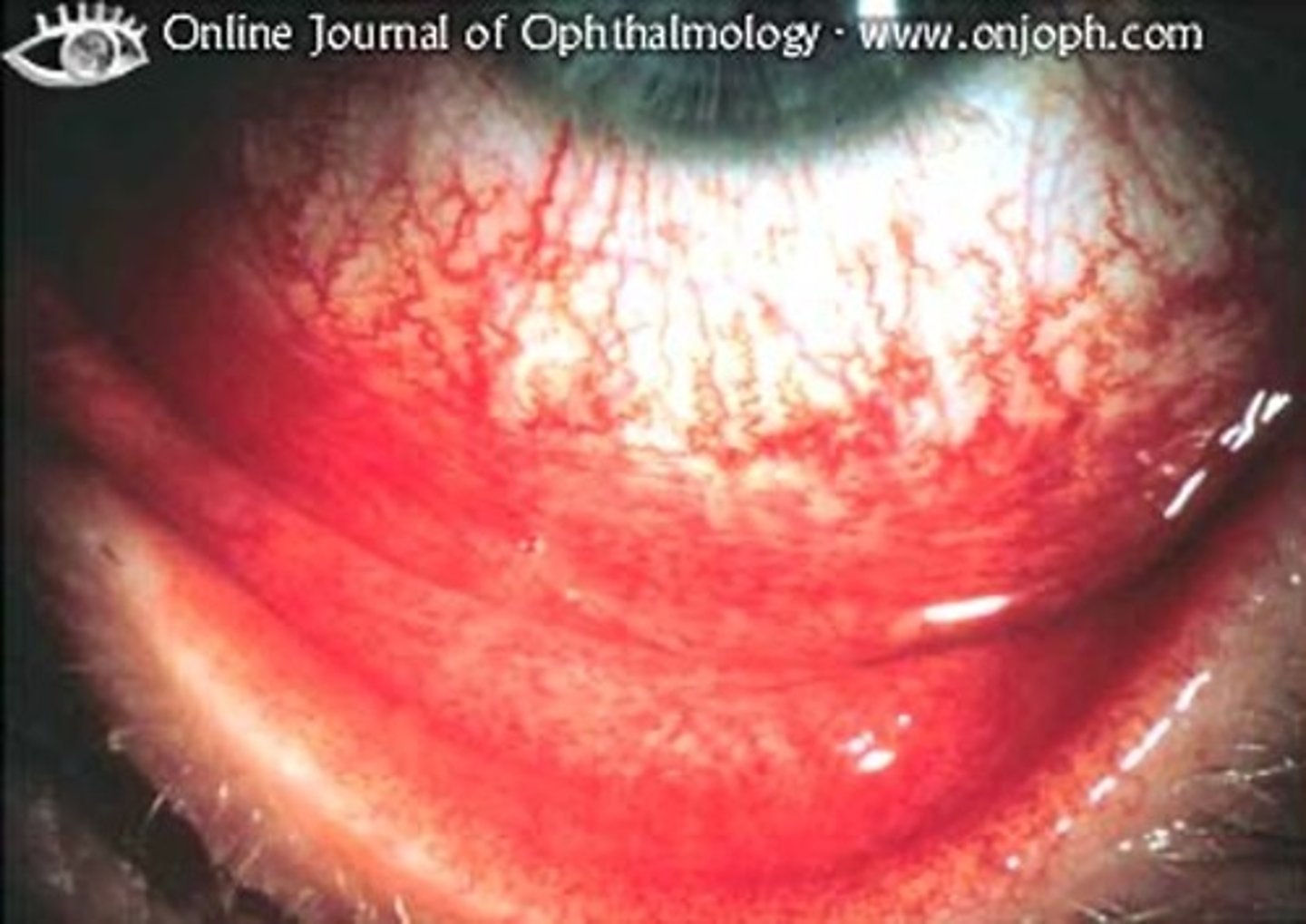 <p>conjunctiva inflammation - pink eye</p><p>- viral!</p>