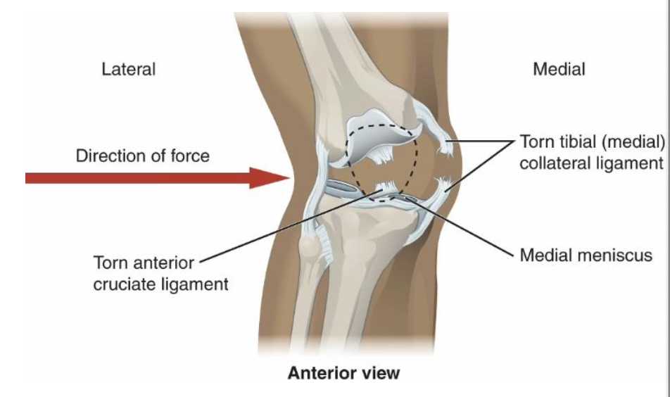 <ul><li><p>ACL tear</p></li><li><p>MCL tear</p></li><li><p>medial meniscus tear</p></li></ul><p></p>
