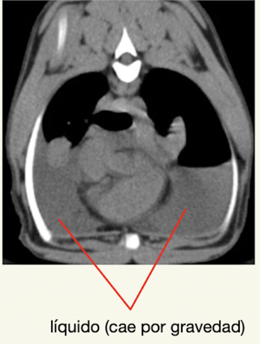 <p>derrame pleural</p>
