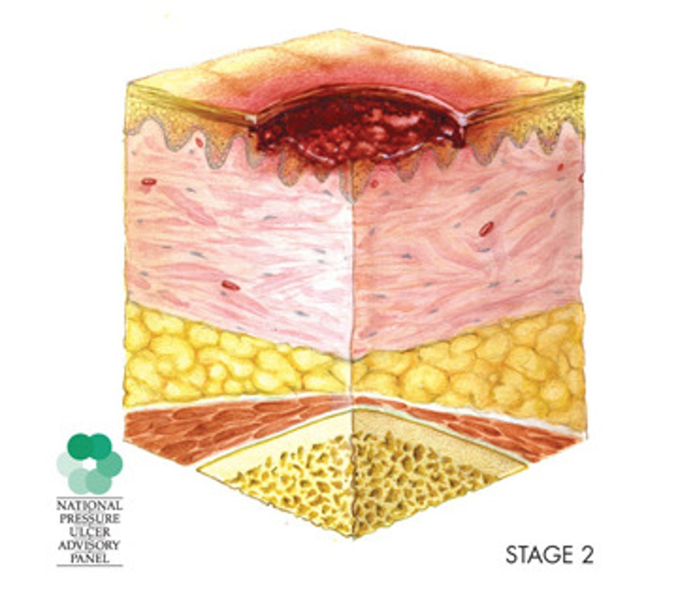 <p>partial-thickness skin loss, including epidermis or dermis</p>