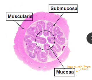 <ul><li><p><span style="background-color: transparent;"><strong><span>Endoscopy & biopsy</span></strong></span></p><ul><li><p><span style="background-color: transparent;"><strong><span>What: </span></strong></span><span style="background-color: transparent; color: green;"><strong><span>Non-invasive</span></strong><span>,</span></span><span style="background-color: transparent;"><span> atraumatic diagnostic tool</span></span></p><ul><li><p>Upper and Lower</p></li></ul></li><li><p><span style="background-color: transparent;"><strong><span>Why: </span></strong></span><span style="background-color: transparent; color: green;"><span>Direct visualization of mucosa</span></span></p><ul><li><p><span style="background-color: transparent;"><strong><span>Pro: </span></strong><span>No Sx incision, Quick recovery, Immediate</span></span></p><ul><li><p><u>Takes 10-15 biopsies in area of interes</u>t</p></li></ul></li><li><p><span style="background-color: transparent;"><strong><span>Con: </span><u><span>Cannot access submucosa or muscularis</span></u></strong><span>, Cannot diagnose mural or extra-luminal dz</span></span></p></li></ul></li></ul></li><li><p><span style="background-color: transparent;"><strong><span>Surgery</span></strong></span></p><ul><li><p><span style="background-color: transparent;"><strong><span>Why:</span></strong><span> </span><strong><u><span>full-thickness biopsies</span></u></strong><span>, large or mural masses, large obx FB removal, when limited endoscopic access</span></span></p><ul><li><p><span style="background-color: transparent;"><strong><span>Pro: </span></strong><span>Allows evaluation of entire abdominal cavity, correct mechanical obx directly</span></span></p></li></ul></li></ul></li></ul><p></p>