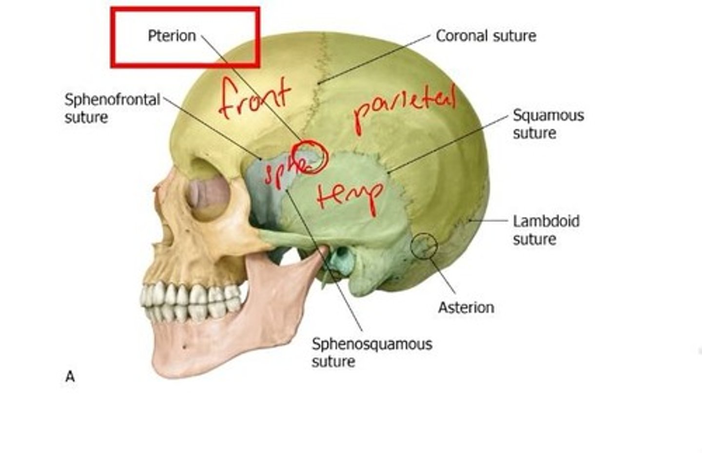 <p>The pterion is the intersection of the frontal, sphenoid, parietal, and temporal bones, with the middle meningeal artery lying underneath.</p>