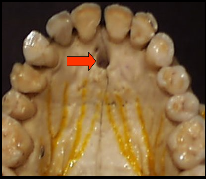 <p><span>an opening, or hole, in bone that is located at the midline of the anterior portion of the hard palate directly posterior to the maxillary central incisors.</span></p>