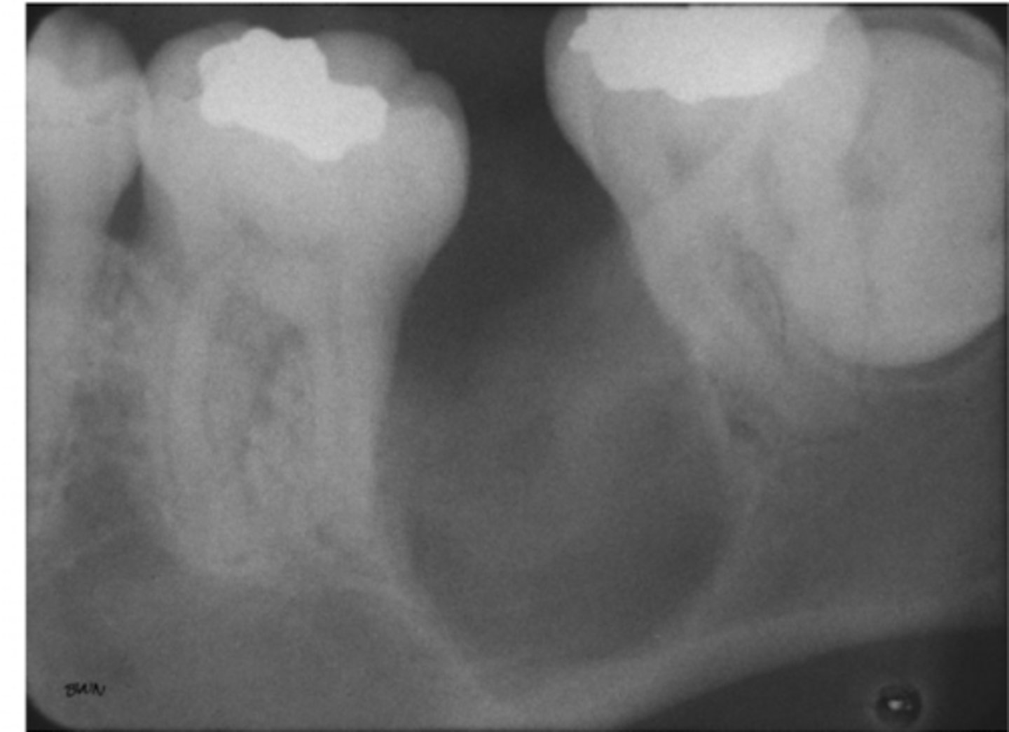 <p>radiolucent; one bubble/cavity</p>
