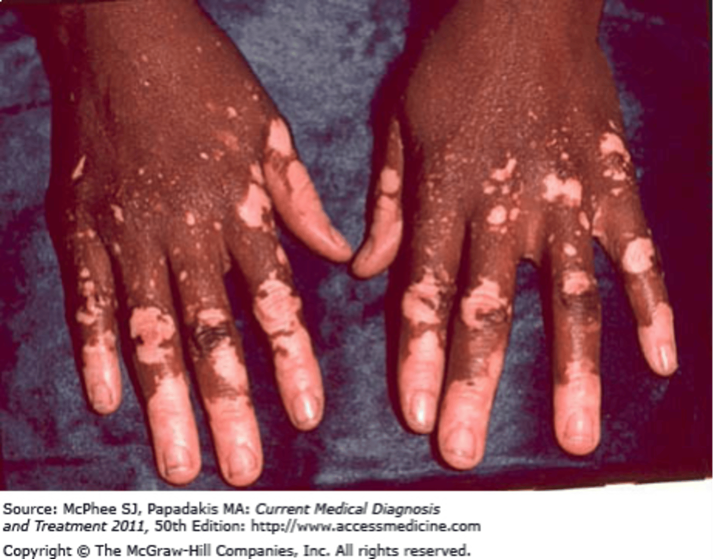 <p>Same as a macule, but &gt; 1 cm</p><p>- Ex: Vitiligo</p>