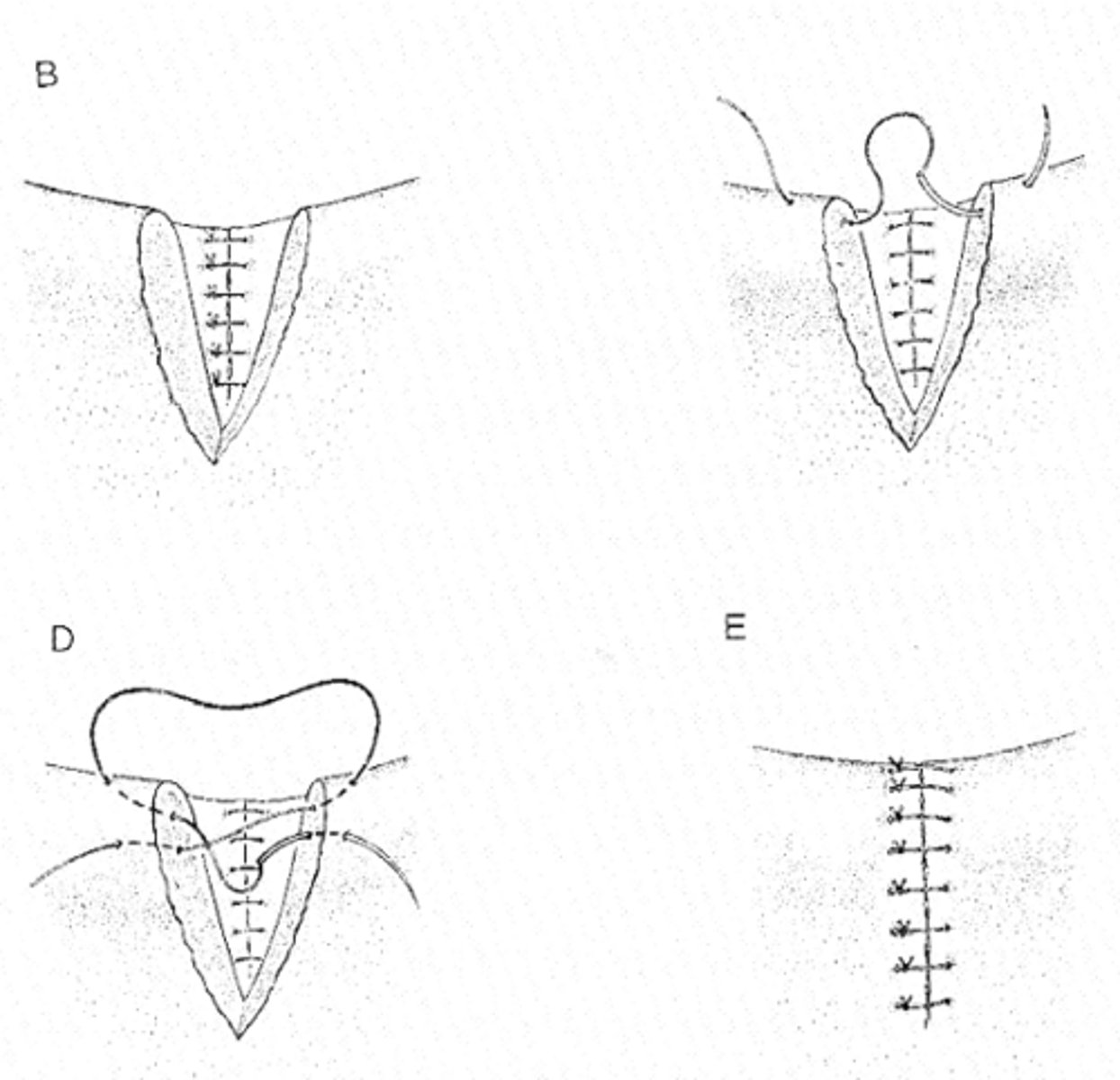 <p>1) Close the conjunctiva with a continuous pattern (start at margin)</p><p>2) Close the skin with a simple interrupted pattern (margin first) or figure 8 pattern</p>