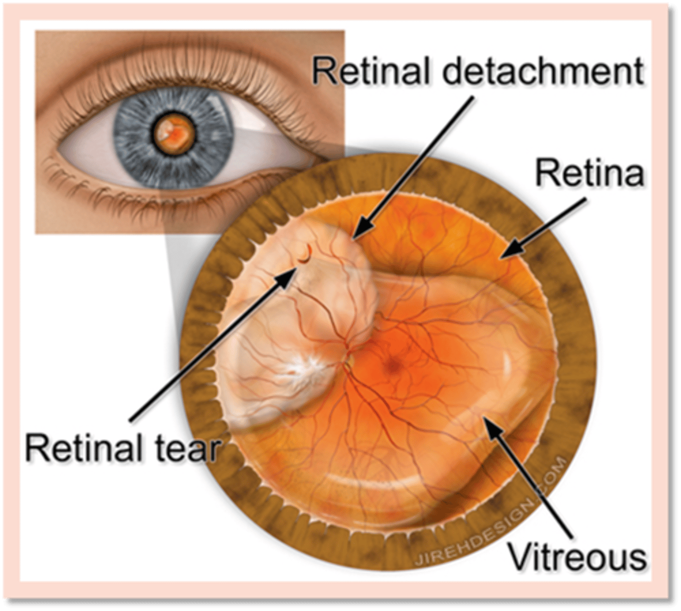 <p>Sudden onset of painless blurred or blacked-out vision, preceded by floaters ("cobwebs") or photopsia (flashes of light). Physical exam may reveal an afferent pupillary defect, and a fundoscopic exam demonstrates ridges of displaced retina flapping in the vitreous humor.</p>