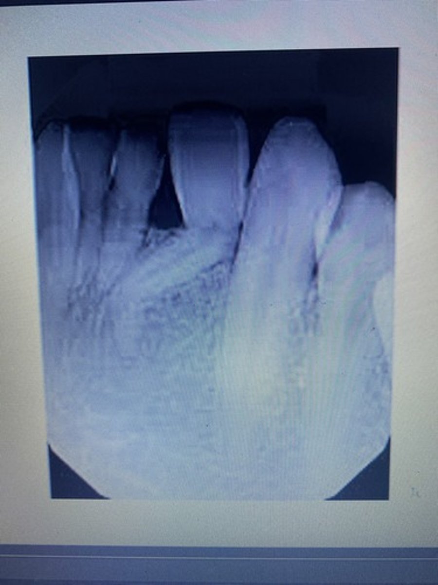 <p>Dilaceration</p>