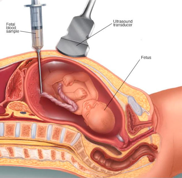 <p>This quick test — also called cordocentesis, fetal blood sampling, or umbilical vein sampling — takes fetal blood directly from the umbilical cord. Doctors use it to check for disorders in the fetus.</p>