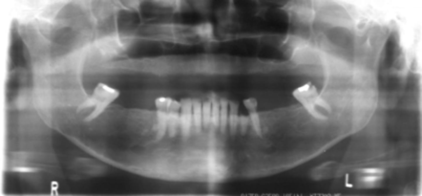 <p>Patient's radiograph shows the following</p><p>•Overall reduction in density of bone.</p><p>•Reduced density and thinning of inferior mandibular cortex</p><p>•Reduction of volume of trabecular bone</p><p>•Lamina dura may appear thinner than normal</p><p>Patient is currently on heparin therapy for pulmonary emboli. What is the diagnosis?</p>