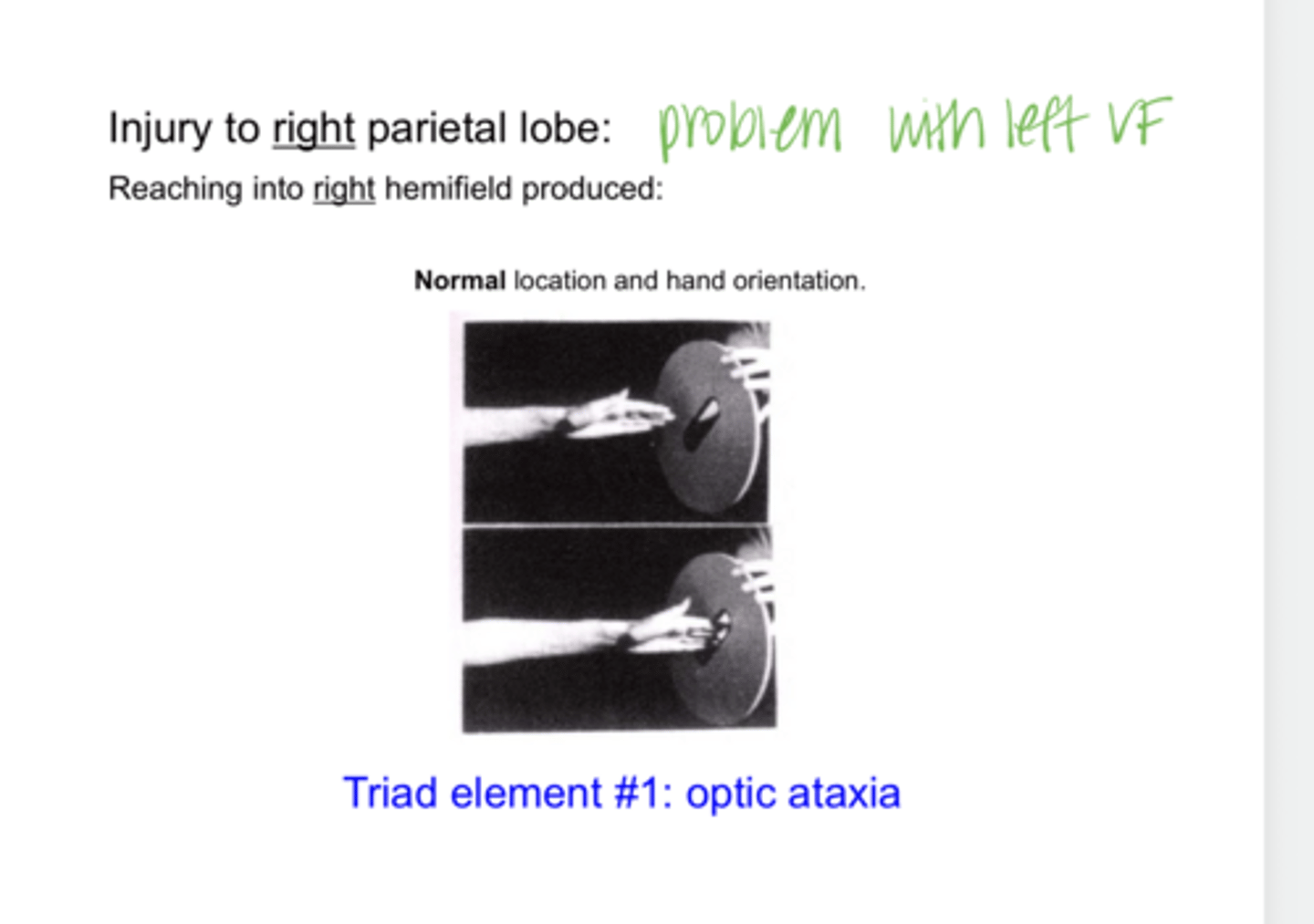 <p>When an injury to the RIGHT parietal lobe is present and the patient reaches into their RIGHT hemifield. What is the result?</p>