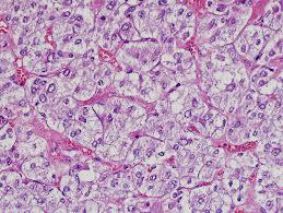 <p>Jugular para-ganglioma of middle ear</p><p>M/P:</p><p>1.Classic nests called “zellballen”; the central cells are rounded with abundant eosinophilic granular cytoplasm.</p><p>2.Sustentacular cells are flat cells &amp; present at the periphery of the nests.</p><p>3.Prominent fibrovascular stroma separates the nests.</p>