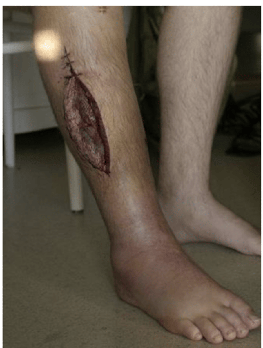 <p>Increased pressure within limited space</p><p>Compromises circulation and function</p><p>-- Screen for signs</p><p>Nerve and muscle death in 8 hrs</p><p>Treatment: Relieve pressure (fasciotomy)</p>