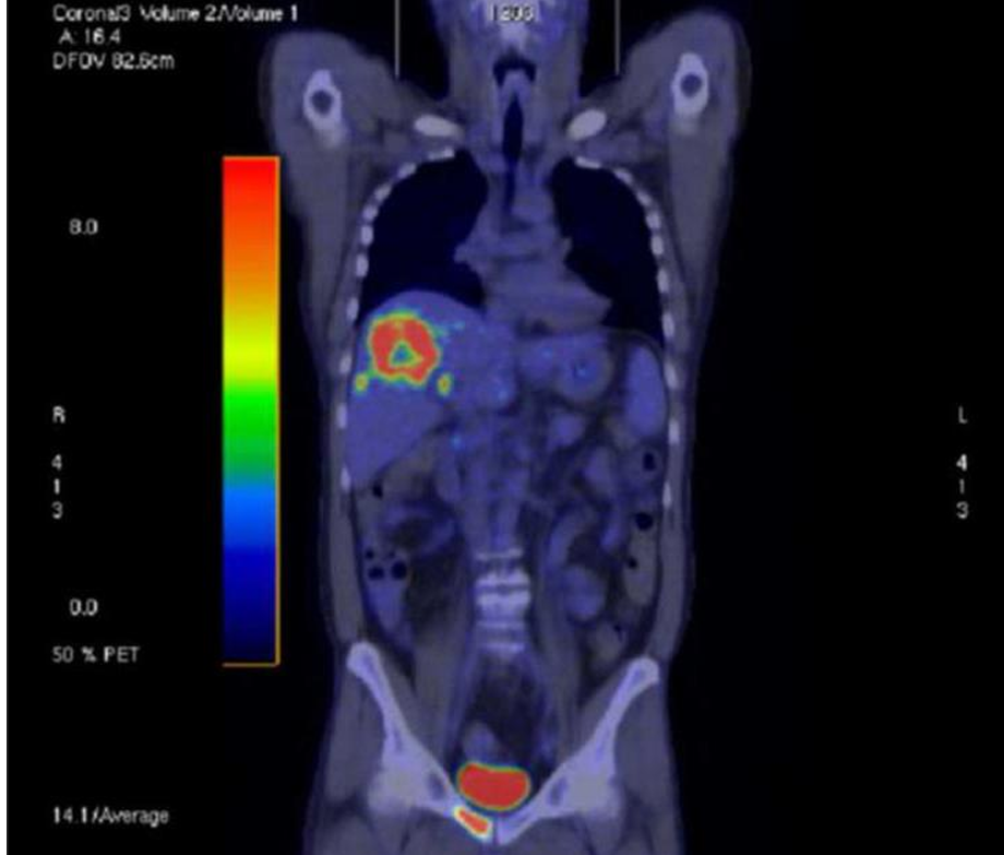<p>Patient history: breast carcinoma, staging </p><p>Modality: PET-CT, 18-fluorodeoxyglucose (18F-FDG) radiotracer; Hybrid imaging method: PET – metabolic activity, CT – morphology </p><p>Region: whole-body, coronal view </p><p>Radiologic sign: Increased fluorodeoxyglucose (18F-FDG) uptake in liver and pubic bone, high physiologic activity is shown in the bladder (normal finding). Liver lesion shows no central uptake, which is a sign of central necrosis. </p><p>Diagnosis: multiple metastases (liver, pubic bone) of breast carcinoma</p>