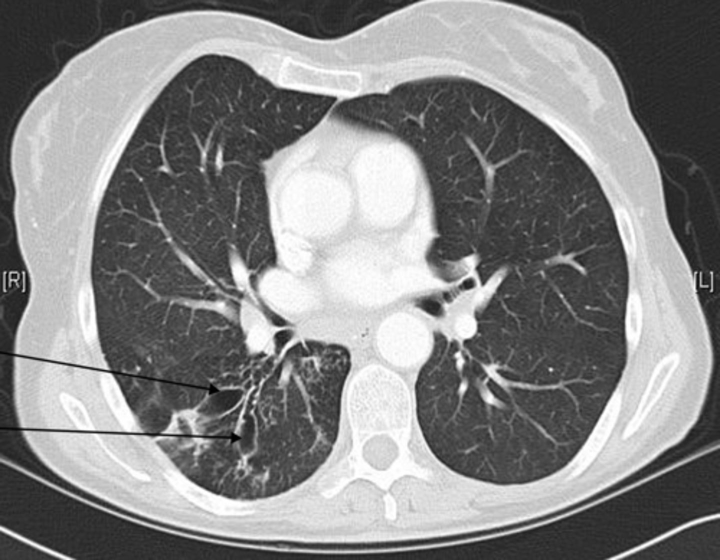 <p>Bronchiectasis</p>