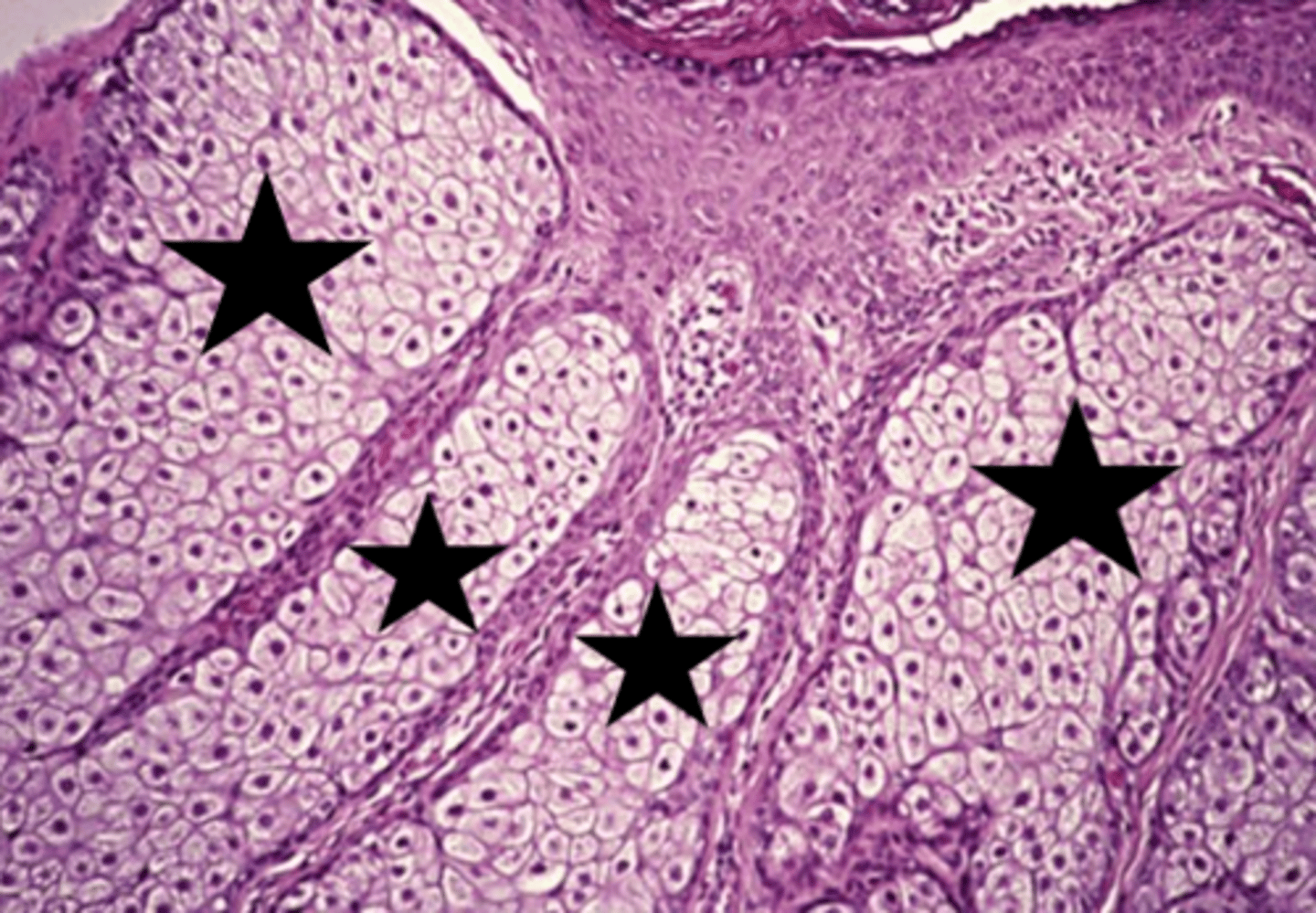 <p>sebaceous hyperplasia histology</p>