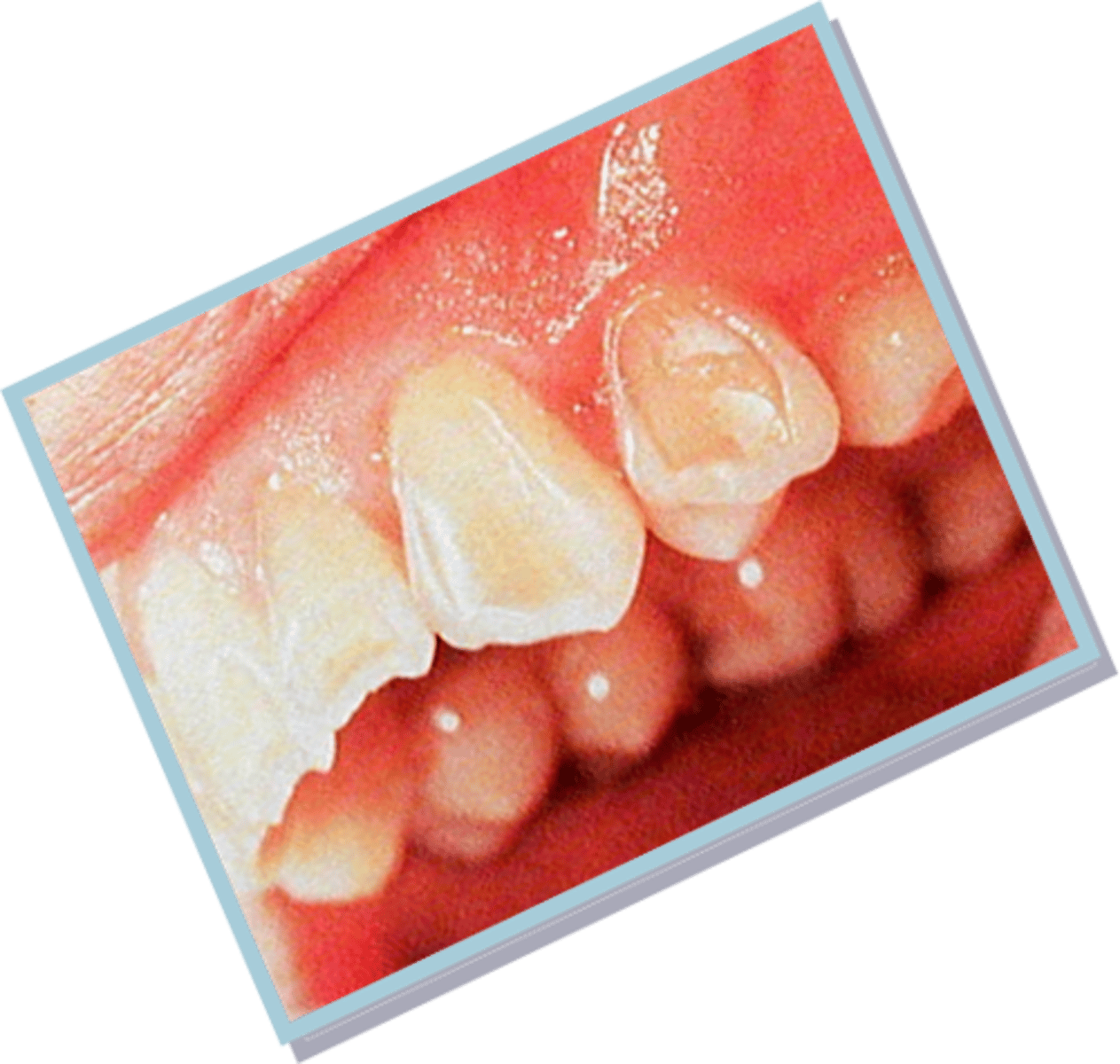 <p>Facial erosion due to acidic beverages</p>