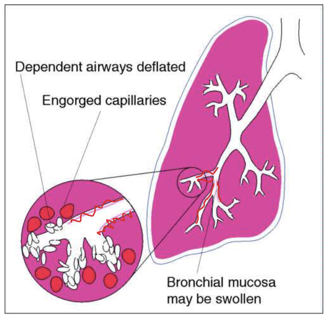 <p>increased pressure in pulmonary vasculature due to fluid overload, causing congestion and interstitial edema around the alveoli and fluid may push into alveoli. Bronchial mucosa may also be edematous </p><ul><li><p>trachea = midline </p></li><li><p>tactile fremitus = normal to decreased </p></li><li><p>percussion = resonant </p></li><li><p>breath sounds = vesicular </p></li><li><p>adventitious sounds = crackles in the dependent portions of lungs, possibly wheezes - fluid alveolar sacks with water </p></li><li><p>may be accompanies by JVD, lower extremity edema, hepatomegaly, DOE </p></li></ul><p></p>