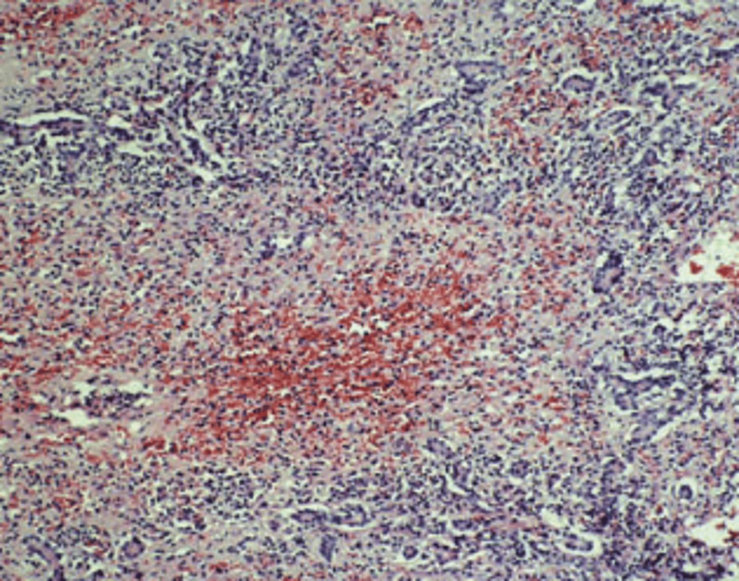 <p>A 25-year-old heroin addict presents in a disoriented state with a 5-day history of fatigue, malaise, and dark-colored urine. Physical examination reveals jaundice and multiple petechial hemorrhages on the upper extremities. Laboratory studies show serum bilirubin of 15.6 mg/dL, mostly in the conjugated form, 10-fold elevations of serum AST and ALT, high levels of blood ammonia, and increased prothrombin time (15 seconds). The patient's condition deteriorates and he develops stage 4 hepatic encephalopathy. A liver biopsy is shown in the image. Which of the following viruses is most likely responsible for the clinical and pathologic ﬁndings in this patient?</p><p>(A) Cytomegalovirus</p><p>(B) Hepatitis A virus</p><p>(C) Hepatitis B virus</p><p>(D) Hepatitis C virus</p><p>(E) Hepatitis E virus</p>