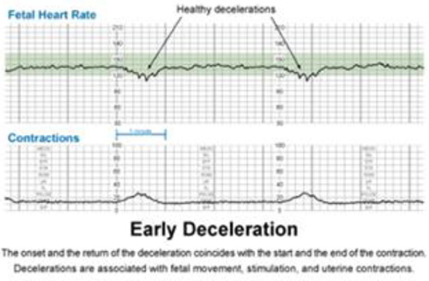 <p>VEAL CHOP</p><p>Head compression - Continue to monitor</p><p>Document findings</p><p>Shows low bumps on FHR monitor that align with contractions</p>