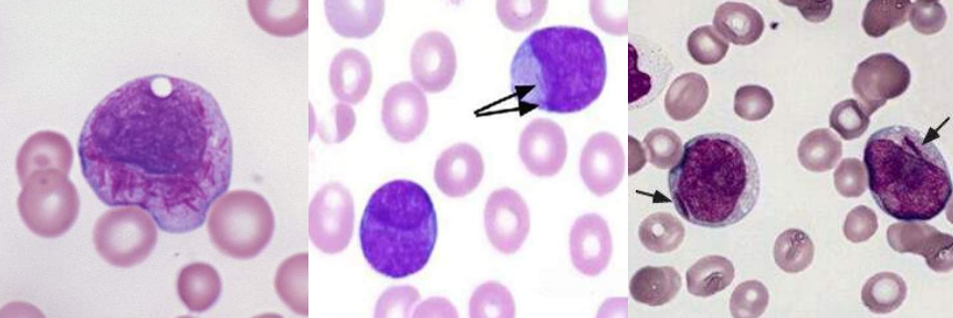 <p>A. Identify the abnormality / cell</p><p>B. This is seen in what condition / disease</p>