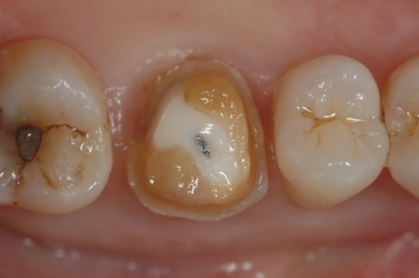 <p>T/F: For a tooth that is prepped where part of the finish line is subgingival and part of it is supragingival, you only need to pack part of the tooth with the sub-G finish line</p>