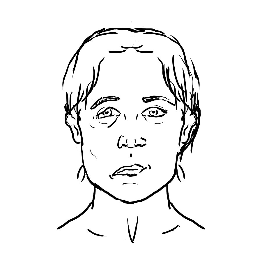 Taken from: https://commons.wikimedia.org/wiki/File:Stroke-facial-droop.jpg