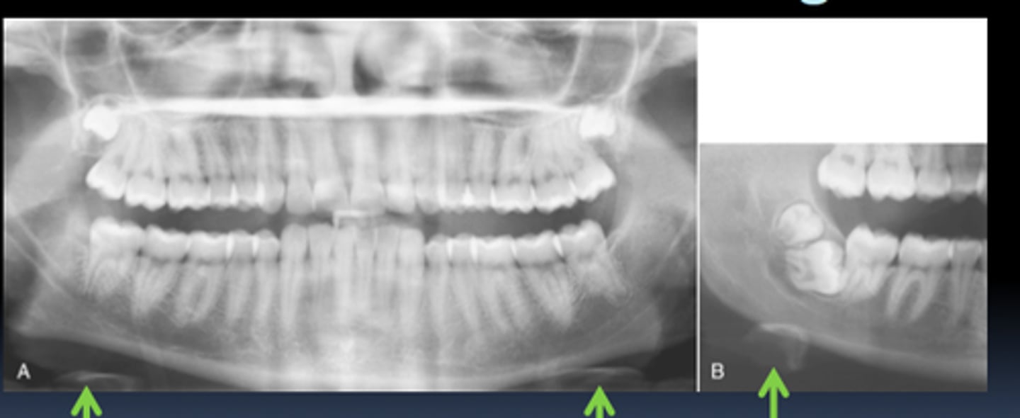 <p>Identify the radiopaque object seen below the mandible on these images</p>