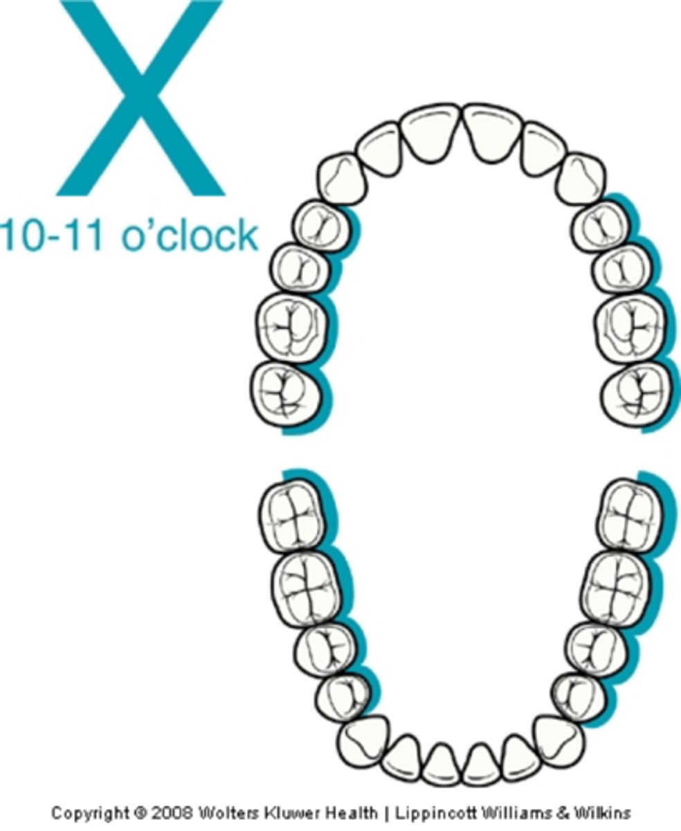 <p>-10-11 o'clock</p><p>-chin down</p><p>-mandibular occlusal plan as parallel to floor as possible</p><p>-head towards</p>