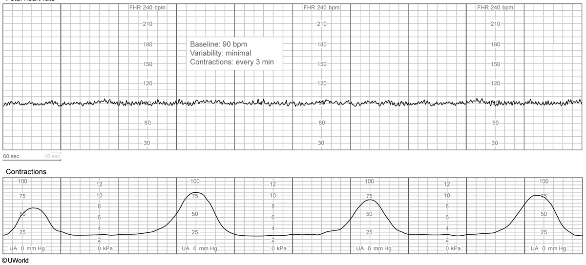 <p>decreased fetal movement &amp; nonpainful but regular contractions, no prenatal care. mother has fatigue, joint stiffness, and erythematous, confluent facial rash</p>