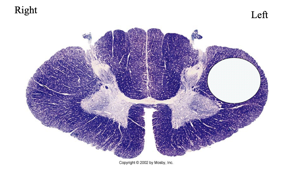 <p>What is lesioned here? What clinical findings would you expect with this lesion?</p>