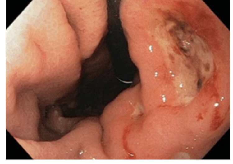 <p>Stomach Pains: Peptic Ulcer Disease</p><ul><li><p>Peptic Ulcer Disease extends into where?</p><ul><li><p>Replaces what?</p></li></ul></li><li><p>Potential for damage to what?</p></li><li><p>Could lead to what?</p></li></ul><p></p><p></p>