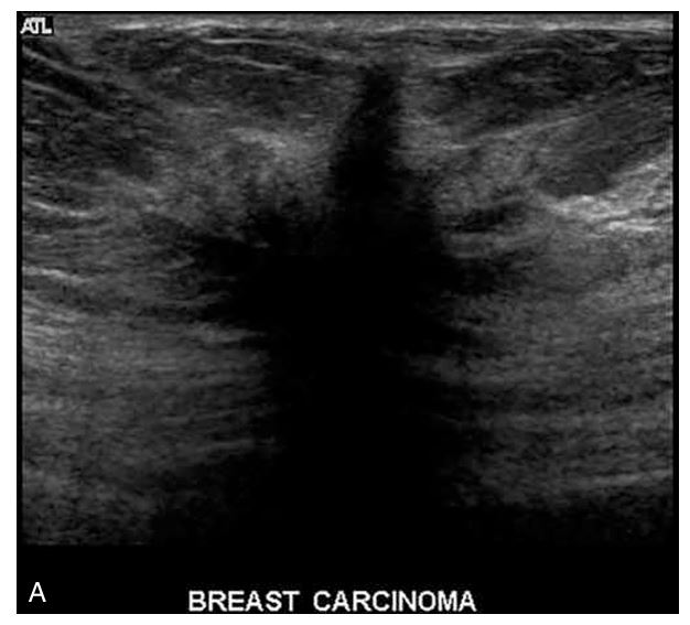 <p>Shadowing behind a solid breast mass is another suspicious sonographic sign for malignancy because malignant tumors tend to be _________</p>