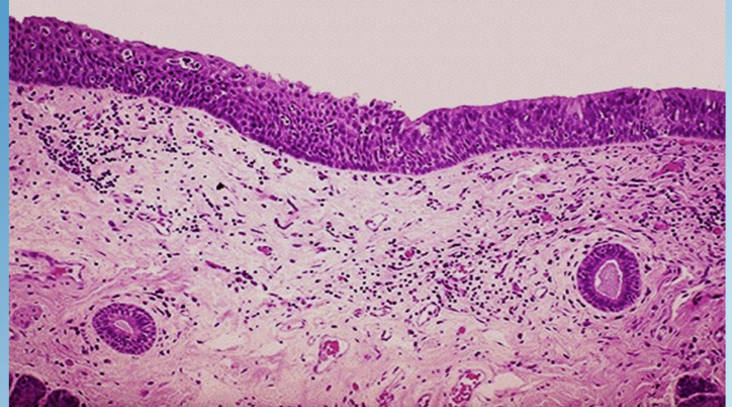 <p>Squamous Metaplasia (Bronchus)</p>