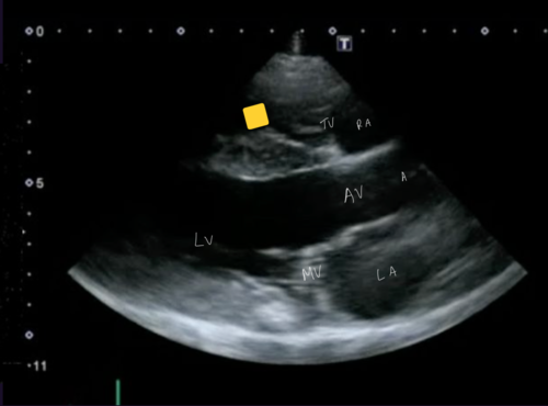 <p>Right parasternal 5 chamber view</p>