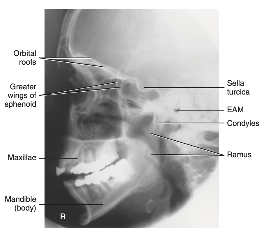 <p>What is <u>best demonstrated</u> for <strong>RT and LT lateral </strong>for <strong>facial bone?</strong></p>