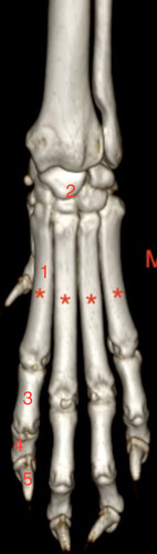 which number is the distal phalanx?