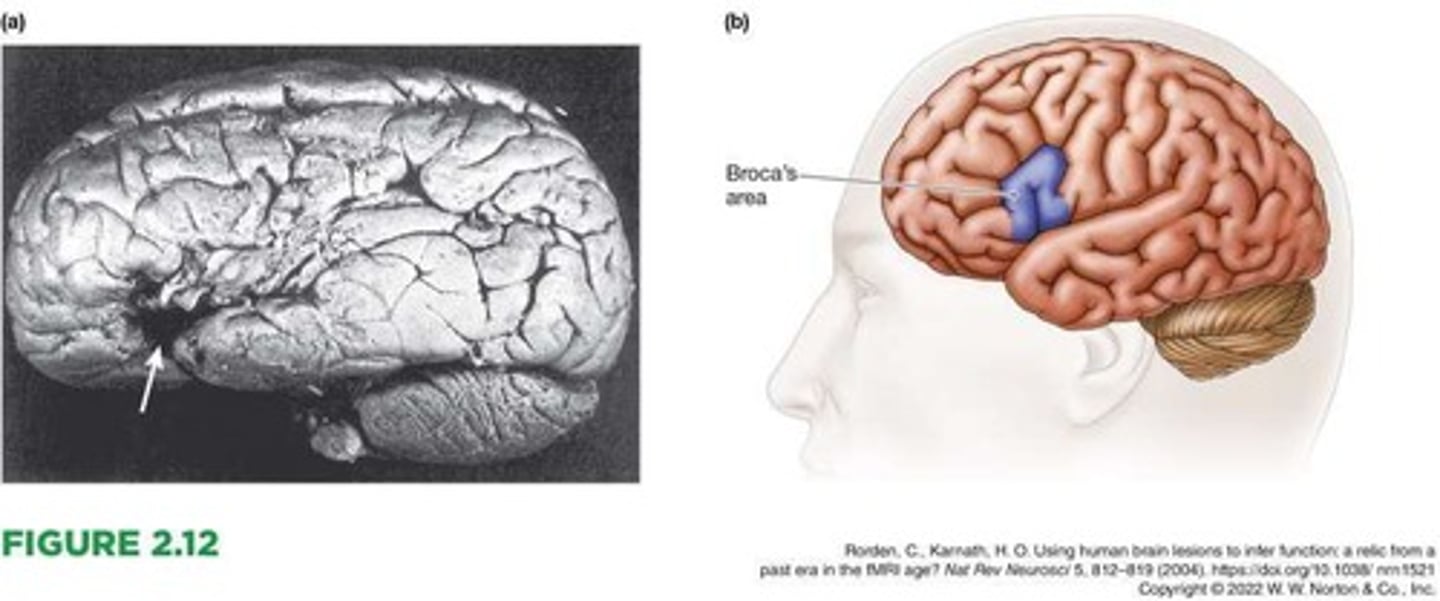 <p>A small portion of the left frontal region of the brain, which is crucial for producing speech.</p>