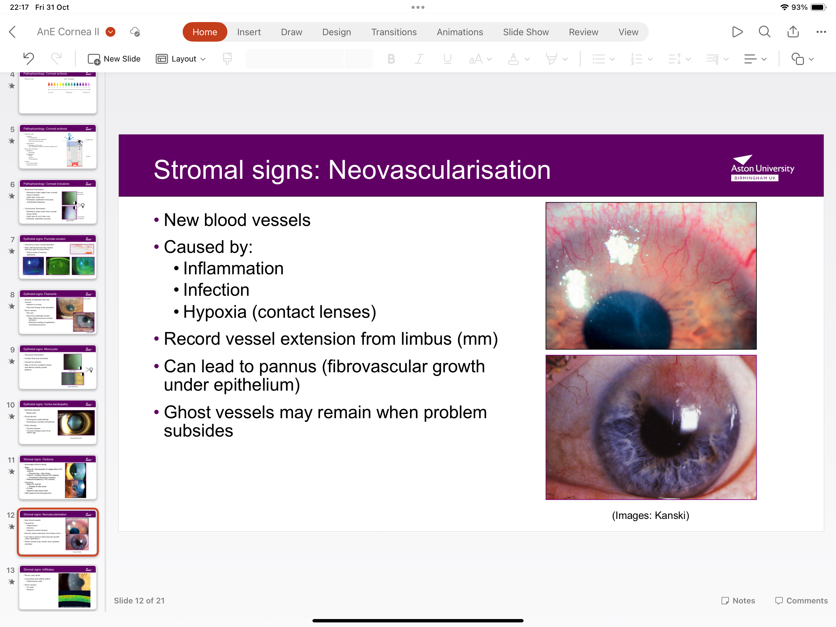 <p>New blood vessels caused by hypoxia from CL, inflammation, infection</p><p>Vessels extend from limbus nd can lead to pannus fibrovascular growth under endothelium)</p>